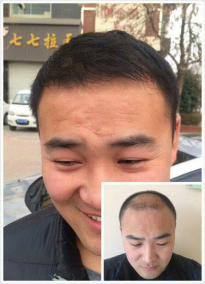 郑州头发加密种植