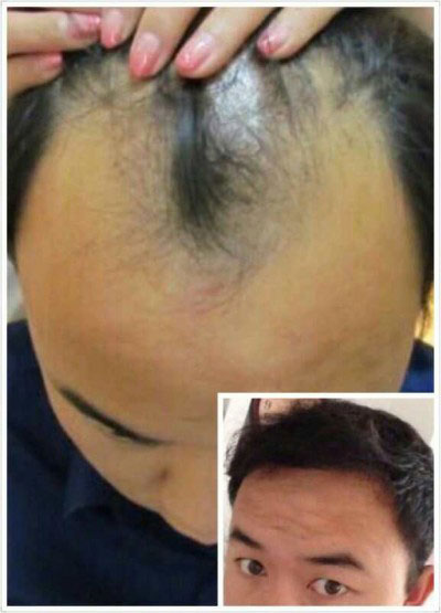 郑州头发毛囊种植医院